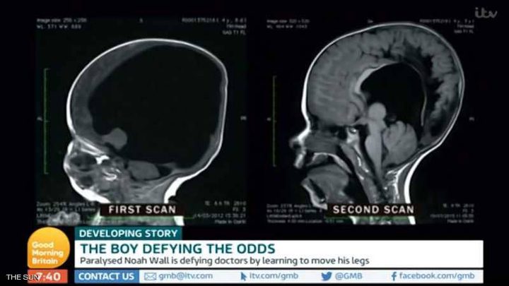 الحالة المعجزة.. طفل "بلا دماغ" يحير العلماء