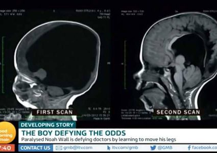 الحالة المعجزة.. طفل "بلا دماغ" يحير العلماء