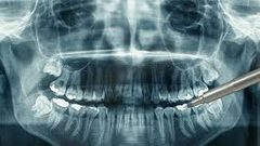 ما الغرض من استخدام الاشعة السينية على أسنانك ؟