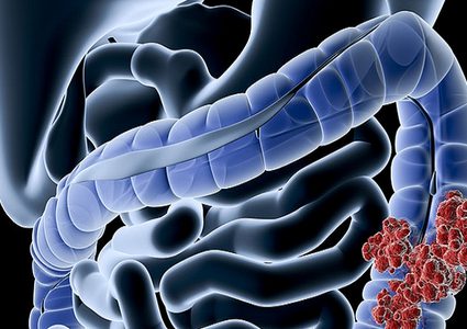مواد غذائية تمنع خطر الإصابة بسرطان قاتل