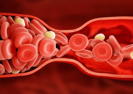 5 أشياء تجعلك عرضة للاصابة بالجلطات الدموية