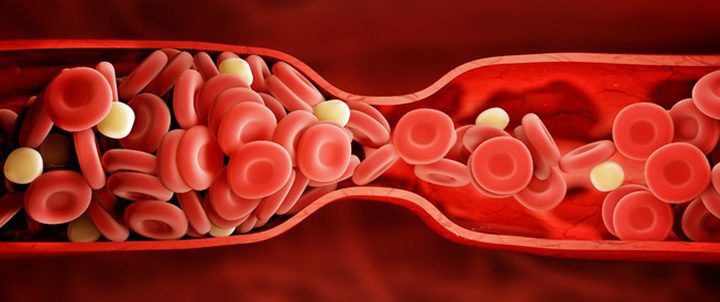 5 أشياء تجعلك عرضة للاصابة بالجلطات الدموية