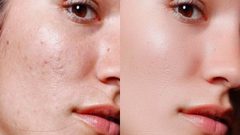 علاج البثور السوداء بطرق مختلفة أبرزها استخدام مقشرات لطيفة على