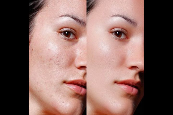 علاج البثور السوداء بطرق مختلفة أبرزها استخدام مقشرات لطيفة على