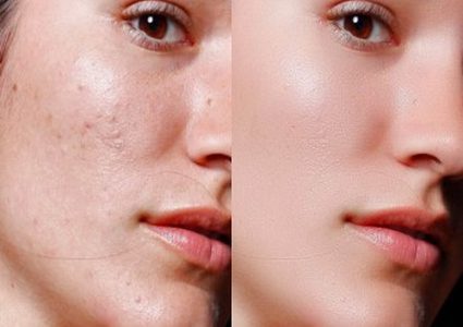 علاج البثور السوداء بطرق مختلفة أبرزها استخدام مقشرات لطيفة على