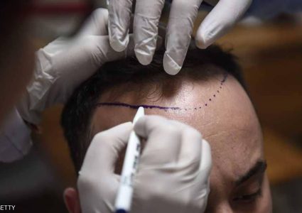 تقنية طبية تسمح بتخزين شعرك لـ"أيام الصلع"