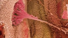 دراسة: التمارين الرياضية تمنع انتشار سرطان الأمعاء في الجسم