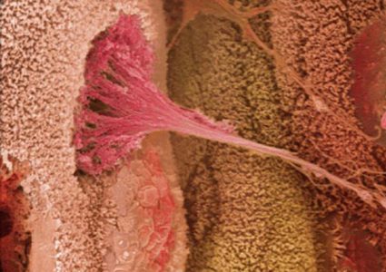 دراسة: التمارين الرياضية تمنع انتشار سرطان الأمعاء في الجسم