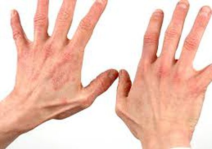 ما هي الأطعمة التي تسبب ظهور الصدفية ؟