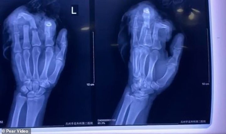 صينى يقطع 4 أصابع من يده بعد خناقة مع زوجته