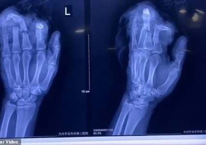 صينى يقطع 4 أصابع من يده بعد خناقة مع زوجته