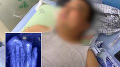 بسبب زوجته..صيني يقطع أصابع يده بالساطور!