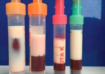 حالة نادرة تحول دم ألماني إلى "حليب" !