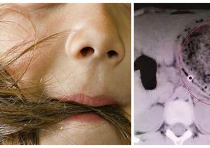 فتاة صينية تأكل شعرها.. والنتيجة كارثية!