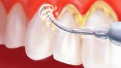 ما هي أضرار تكون طبقة من الجير على الأسنان ؟