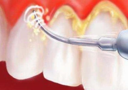 ما هي أضرار تكون طبقة من الجير على الأسنان ؟