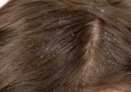 قشرة الرأس قد ترتبط بمرض خطير