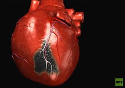 علماء روس يبتكرون طريقة لتدمير الجلطة الدموية