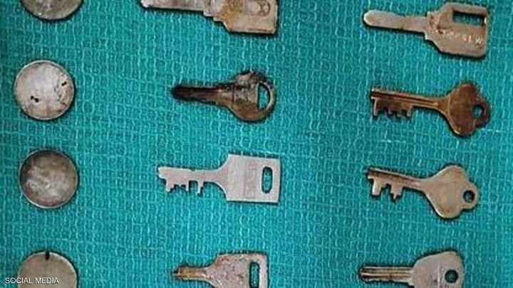 الهند.. استخراج 40 قطعة معدنية من معدة "الرجل المغناطيس"