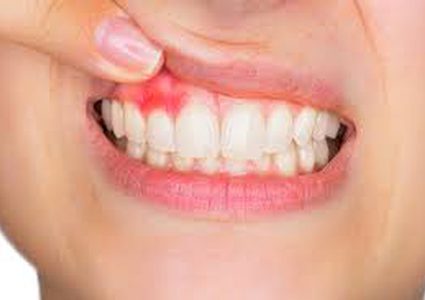 6 طرق بسيطة للتخلص من نزيف اللثة