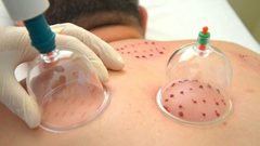 صحة غزة: تمنع الحجامة خارج المؤسسات الصحية الرسمية