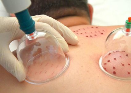 صحة غزة: تمنع الحجامة خارج المؤسسات الصحية الرسمية
