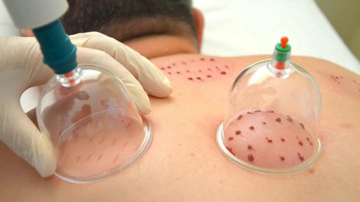 صحة غزة: تمنع الحجامة خارج المؤسسات الصحية الرسمية