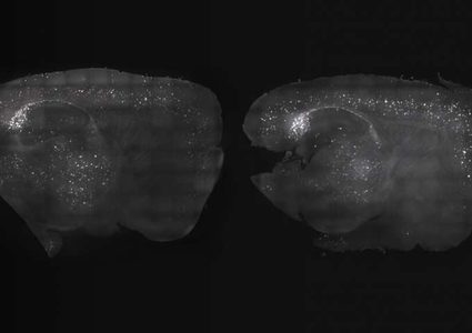دراسة: تحفيز موجات الدماغ يعالج أعراج مرض الزهايمر