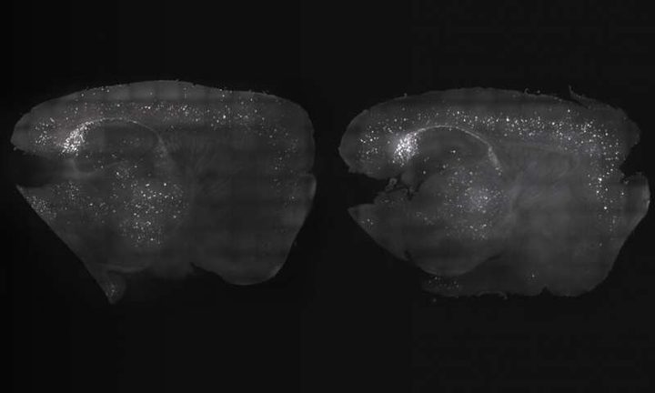 دراسة: تحفيز موجات الدماغ يعالج أعراج مرض الزهايمر