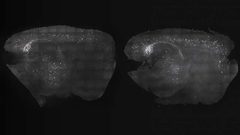 دراسة: تحفيز موجات الدماغ يعالج أعراج مرض الزهايمر