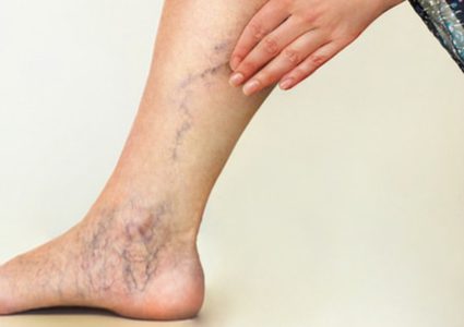 طرق الحفاظ على صحة الأوردة في جسمك