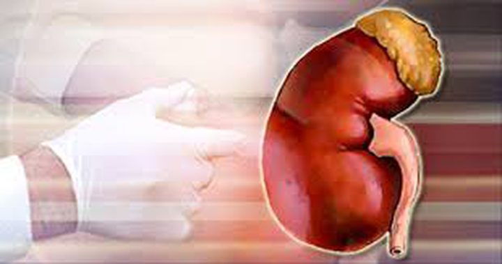 الهولميوم ليزر.. علاج آمن لحصوات الكلى‬