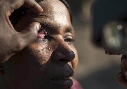 دراسة: التوصل إلى علاج محتمل لمرضي العمى النهري وداء الفيل