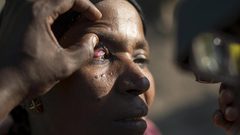 دراسة: التوصل إلى علاج محتمل لمرضي العمى النهري وداء الفيل