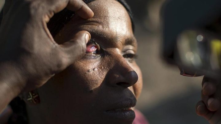 دراسة: التوصل إلى علاج محتمل لمرضي العمى النهري وداء الفيل