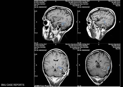 من الأذن إلى الجمجمة.. انهار ونقل للمستشفى بسبب "عود القطن"