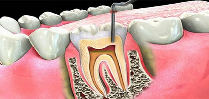 عصب الأسنان ..أعراضه وعلاجه