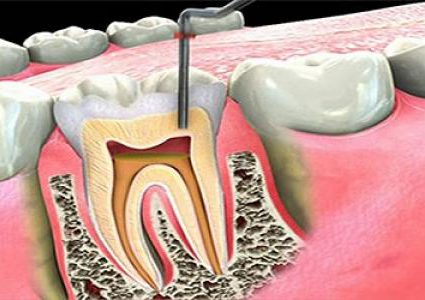 عصب الأسنان ..أعراضه وعلاجه