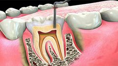 عصب الأسنان ..أعراضه وعلاجه