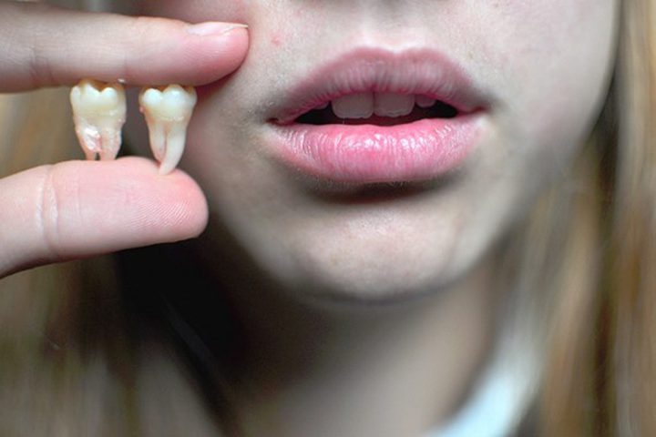 ما هي العلاقة بين فقدان الأسنان وظهور التجاعيد في الوجه ؟