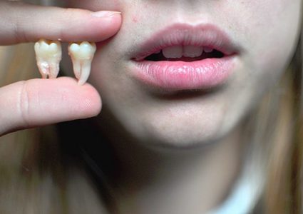 ما هي العلاقة بين فقدان الأسنان وظهور التجاعيد في الوجه ؟