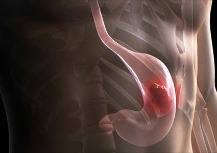 سرطان المعدة واعراضه