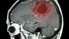 مصابون بسرطان الدماغ يكشفون أعراضا لم يعيروها سابقا أي أهمية