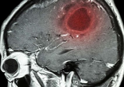 مصابون بسرطان الدماغ يكشفون أعراضا لم يعيروها سابقا أي أهمية