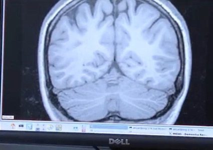 باحثون : التدخين لا يسبب الزهايمر