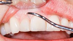 ما هي علامات اضطراب المناعة الذاتية التي تظهر على الاسنان ؟