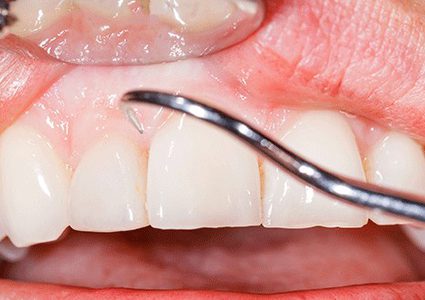 ما هي علامات اضطراب المناعة الذاتية التي تظهر على الاسنان ؟