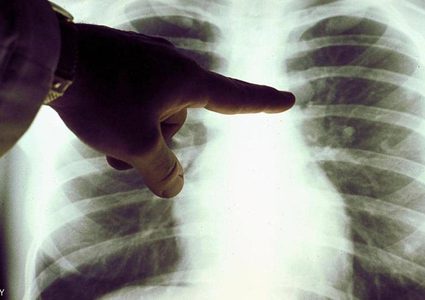 دراسة.. "استنشاق السكر" يعالج أمراضا خطيرة