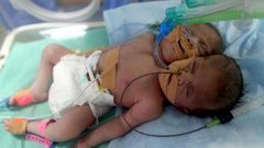 ولادة نادرة في مصر.. طفل برأسين وقلب واحد
