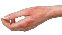 طرق ​​​​​​​​علاج الطفح الجلدي في المنزل